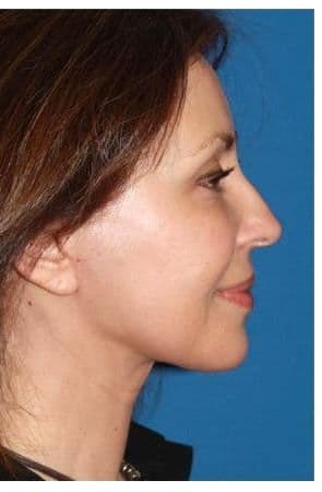 Facelift, after
