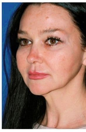 Facial Rejuvenation, before