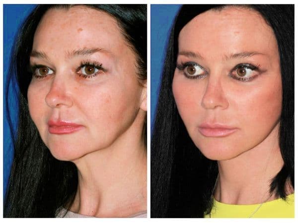 Facial Rejuvenation: before (left) and after (right)