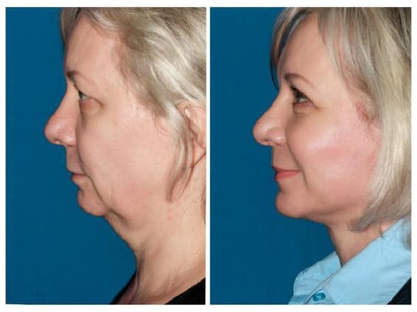 Neck Lift: before (left) and after (right)